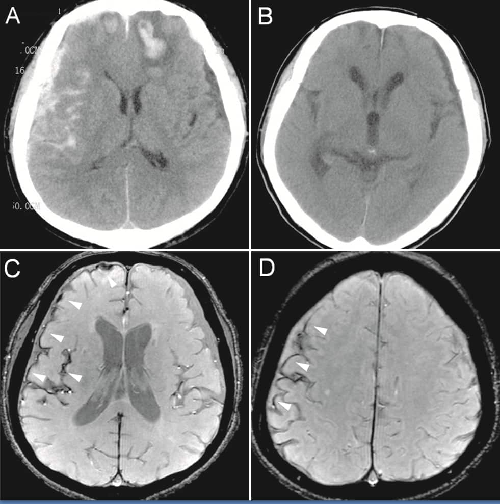 CT and MRI of cerebral hemorrhages and effective T2 MRI of subsequent hemosiderosis.png